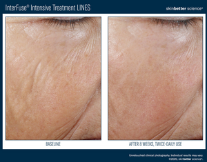 InterFuse Intensive Treatment / LINES